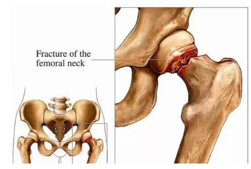 骨密度檢測儀廠家提示為什么髖部骨折會稱之為“人生道路最后一次骨折”？