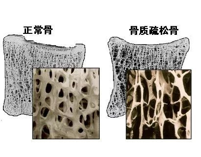 7.23超聲波骨密度分析儀廠家提醒你離骨折疏松有多遠